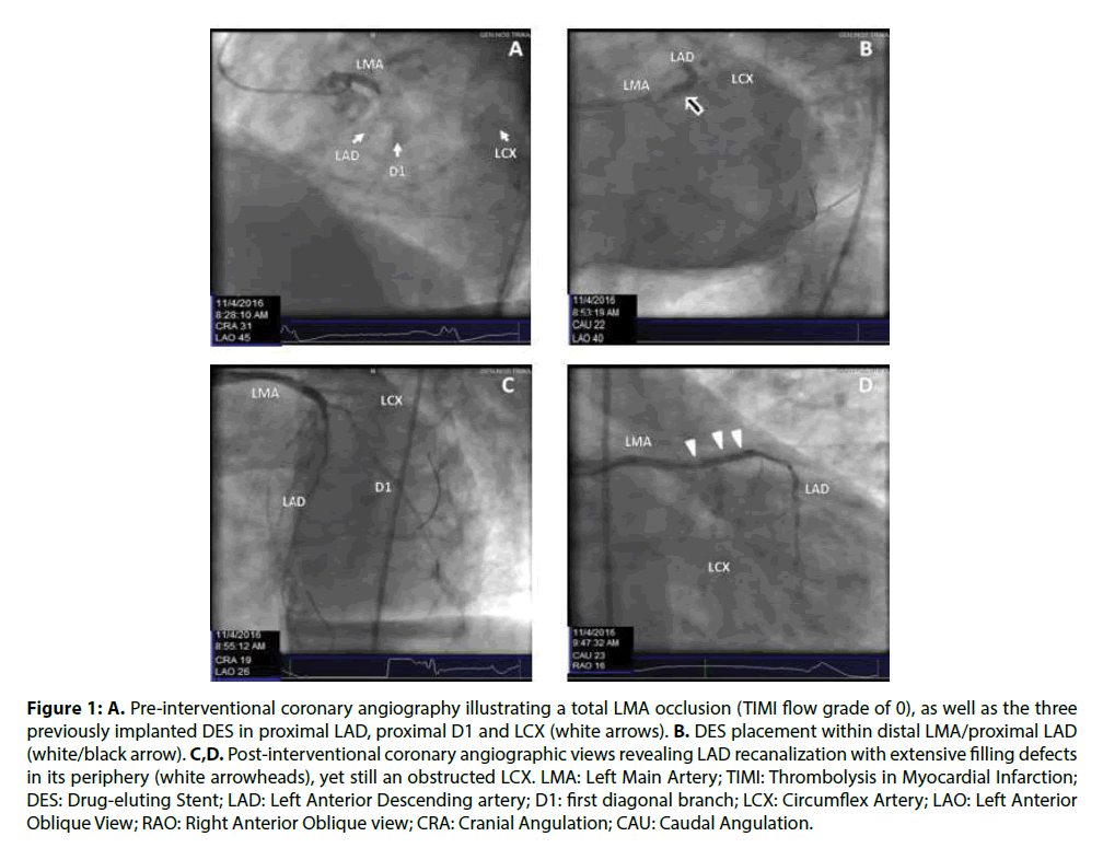 interventional-cardiology-LMA-occlusion