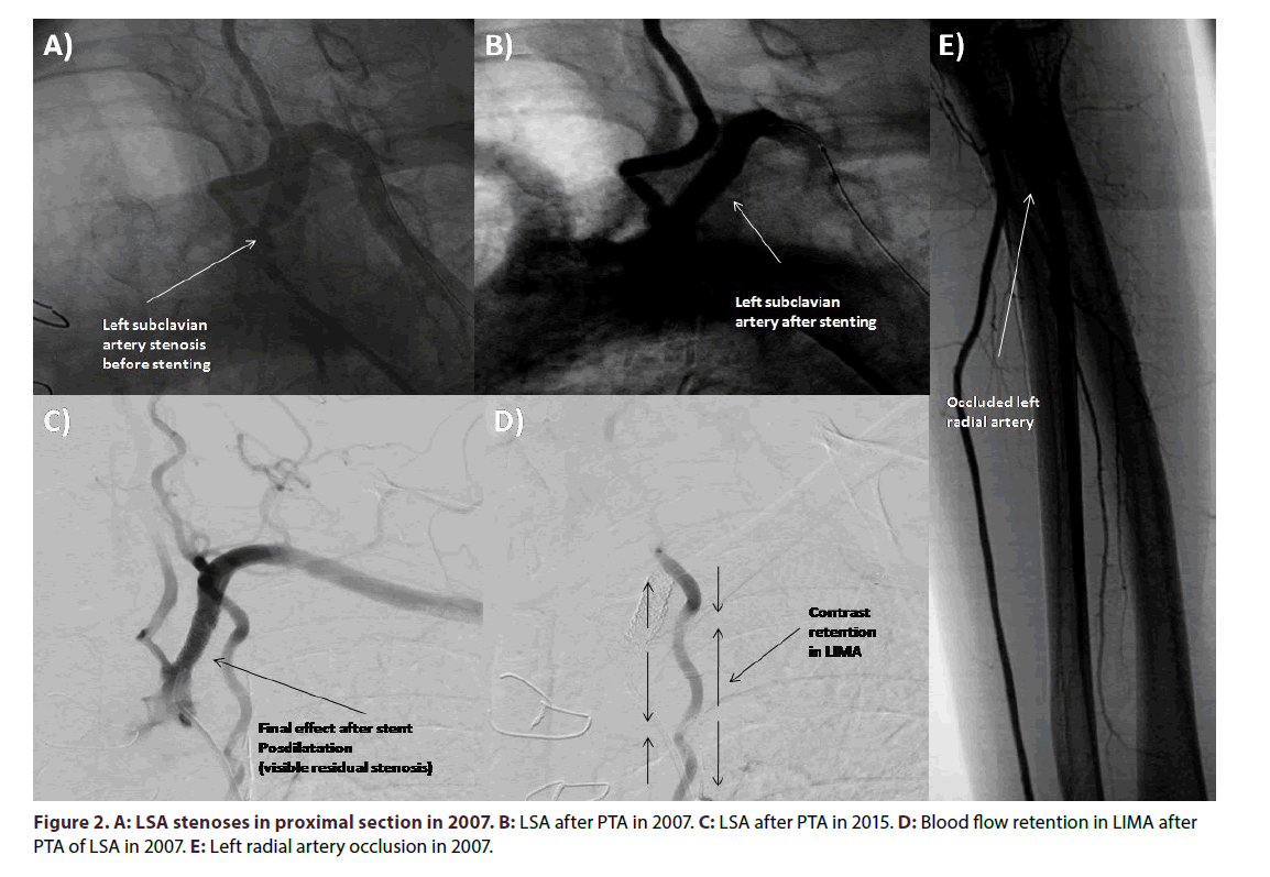 interventional-cardiology-LSA-stenoses-proximal