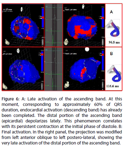 interventional-cardiology-Late-activation