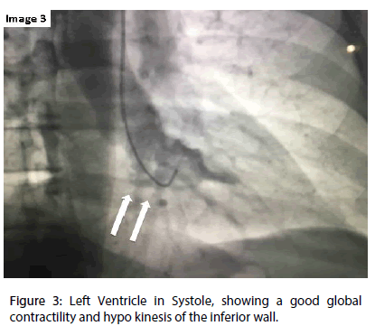 interventional-cardiology-Left-Ventricle