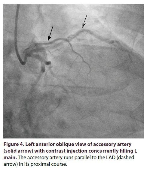 interventional-cardiology-Left-anterior