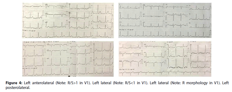 interventional-cardiology-Left-anterolateral