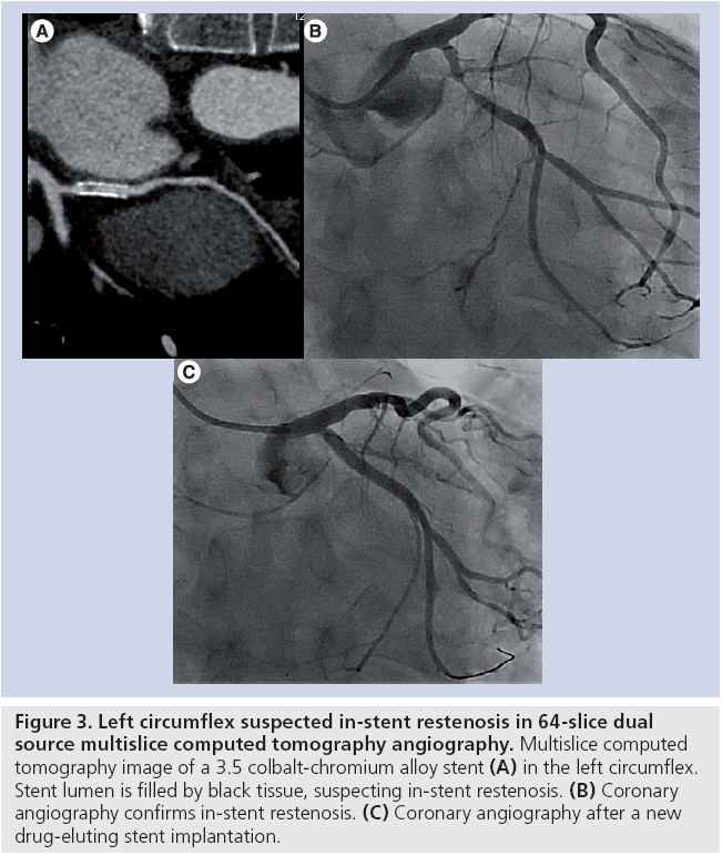 interventional-cardiology-Left-circumflex-suspected