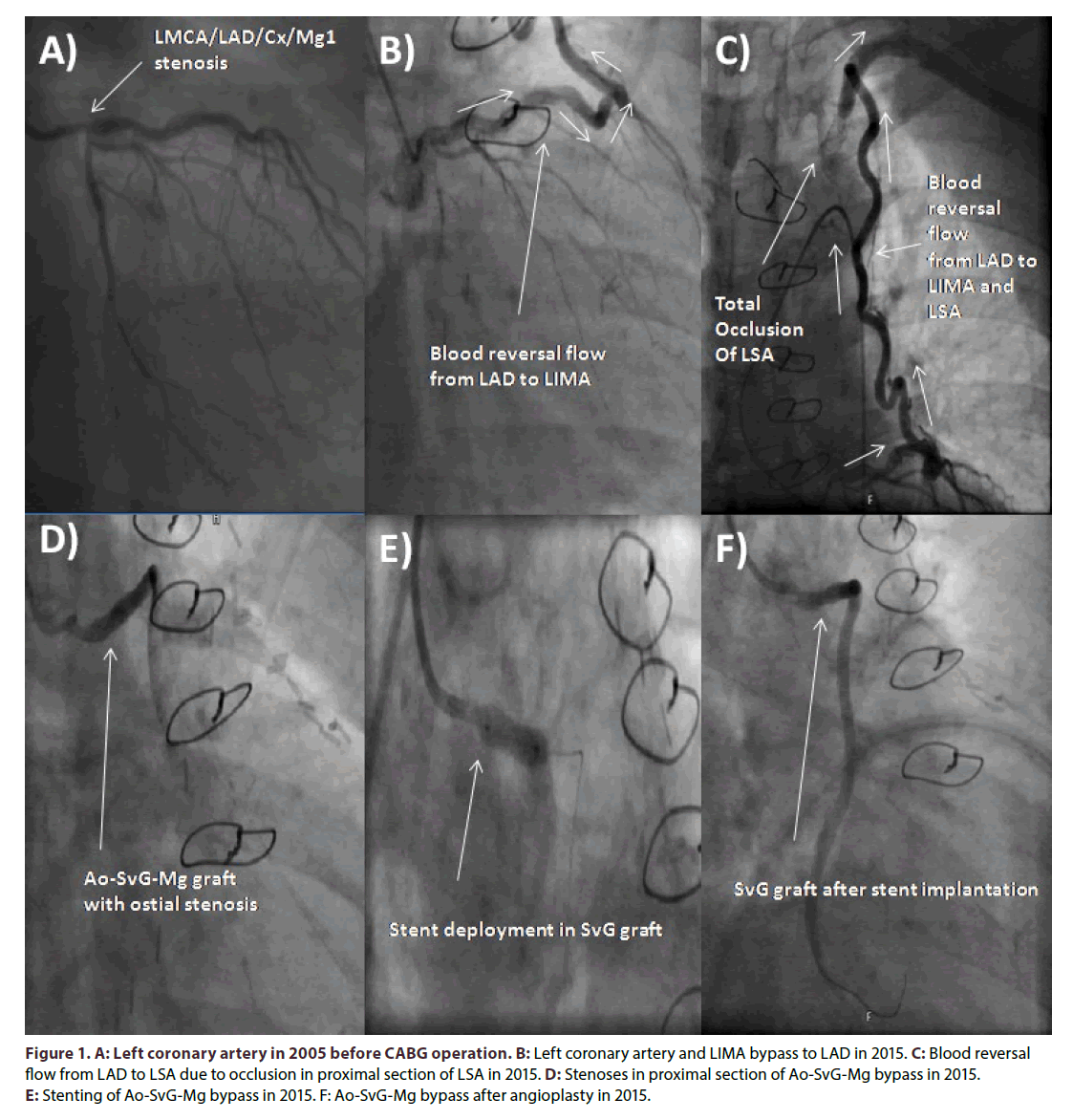 interventional-cardiology-Left-coronary-artery