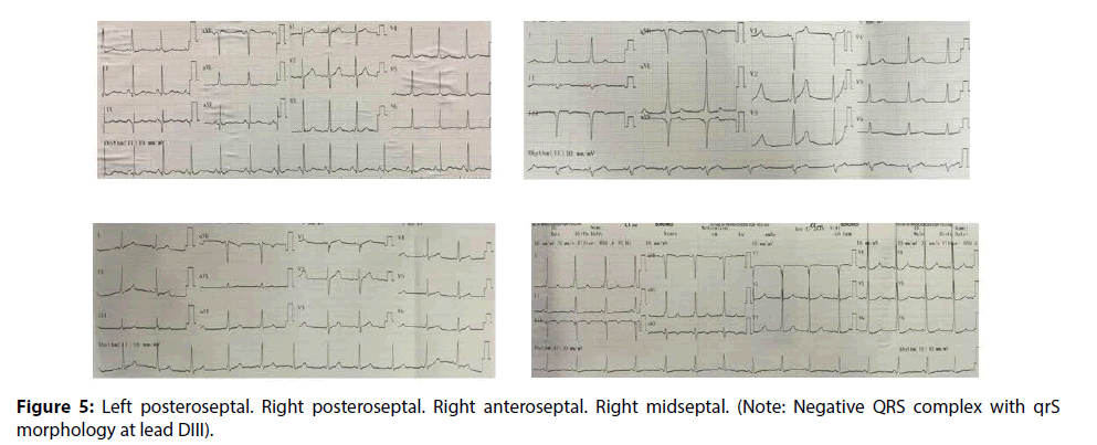 interventional-cardiology-Left-posteroseptal