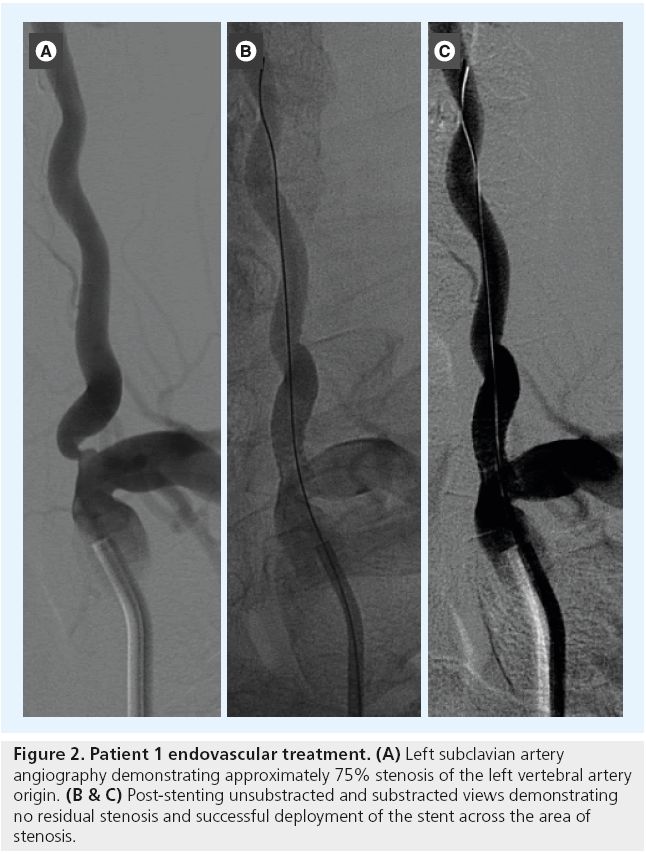 interventional-cardiology-Left-subclavian-artery