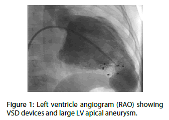 interventional-cardiology-Left-ventricle