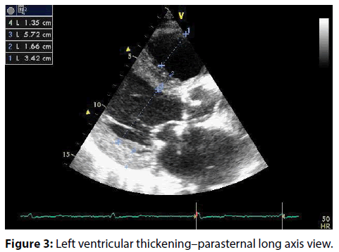interventional-cardiology-Left-ventricular