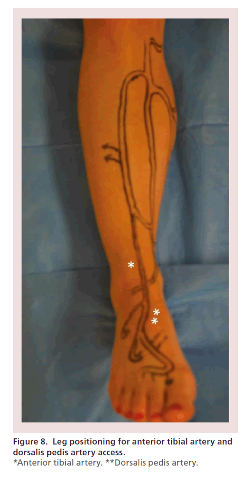 interventional-cardiology-Leg-positioning