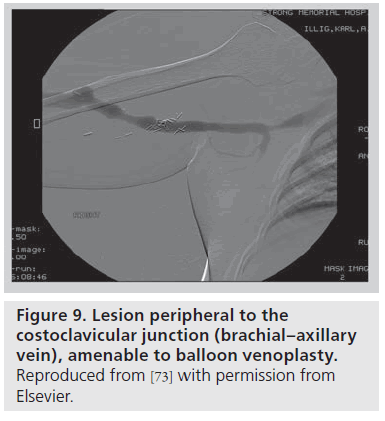 interventional-cardiology-Lesion-venoplasty