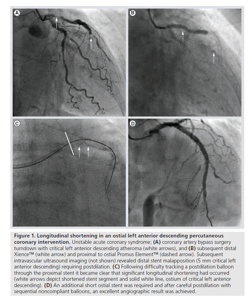 interventional-cardiology-Longitudinal-shortening