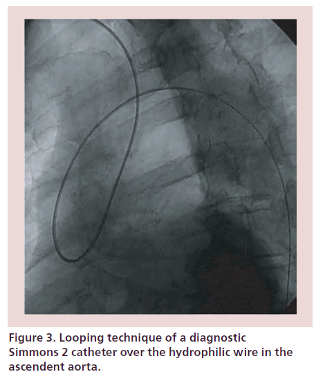 interventional-cardiology-Looping-technique
