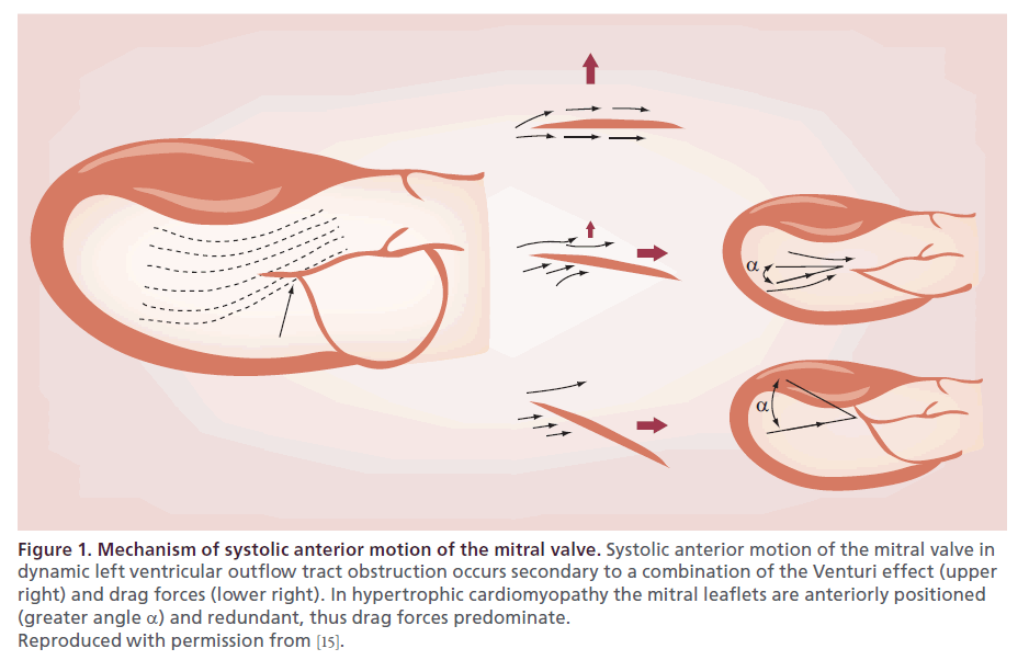 interventional-cardiology-Mechanism-systolic