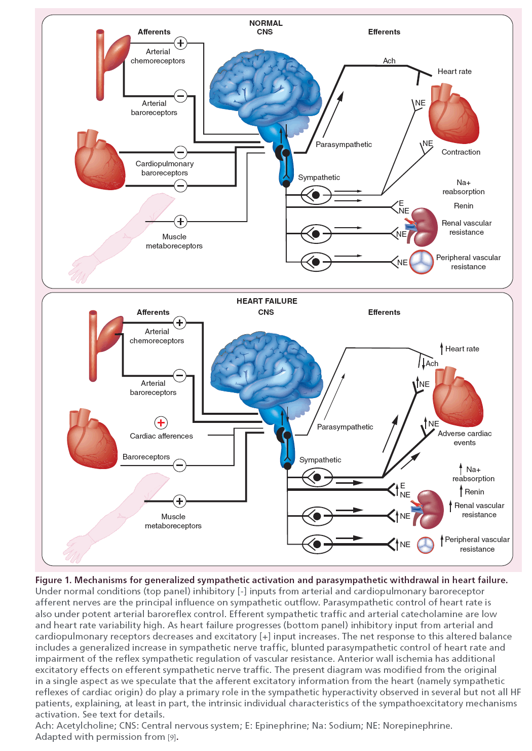 interventional-cardiology-Mechanisms-generalized