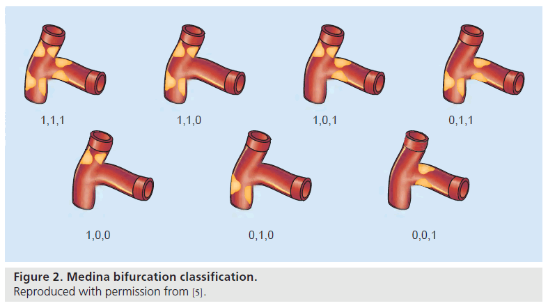 interventional-cardiology-Medina-bifurcation