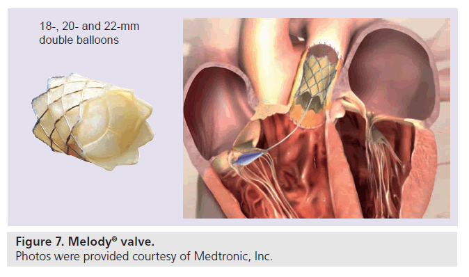 interventional-cardiology-Melody