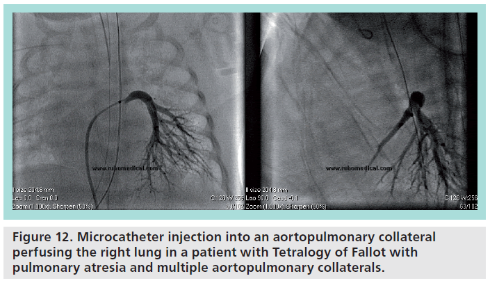 interventional-cardiology-Microcatheter-injection