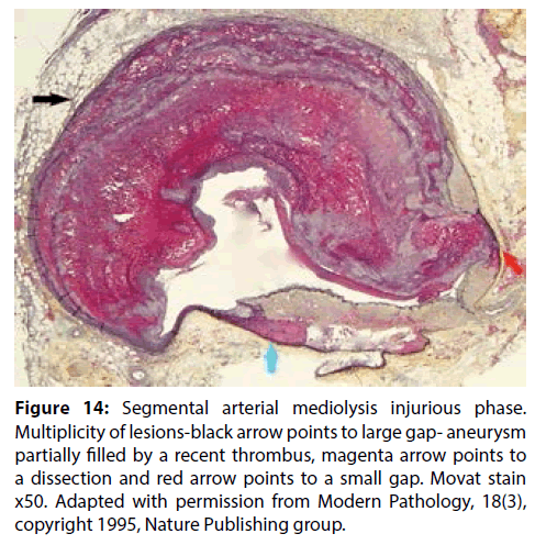 interventional-cardiology-Modern-Pathology