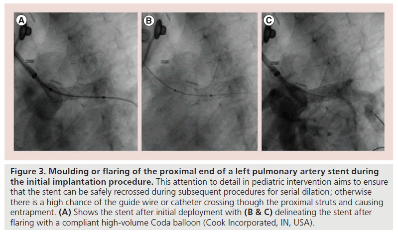 interventional-cardiology-Moulding-flaring