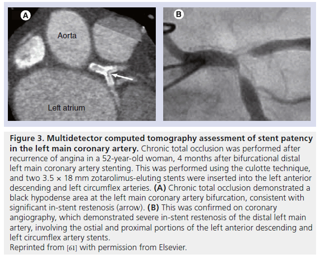 interventional-cardiology-Multidetector-computed