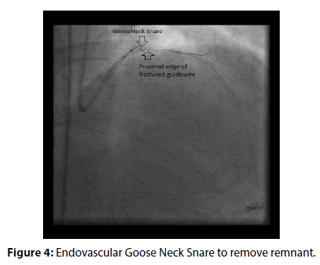 interventional-cardiology-Neck-Snare