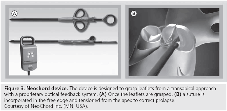 interventional-cardiology-Neochord-device