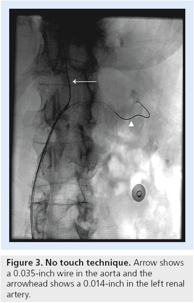 interventional-cardiology-No-touch-technique