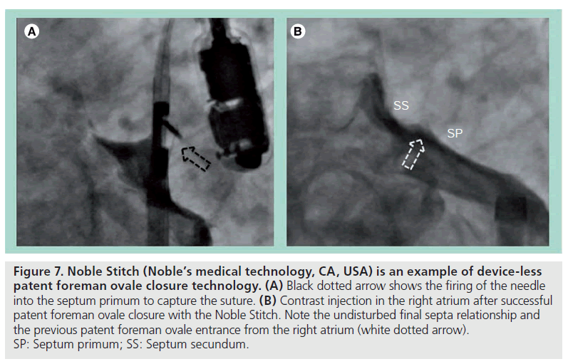 interventional-cardiology-Noble-Stitch-2-1-85-g007