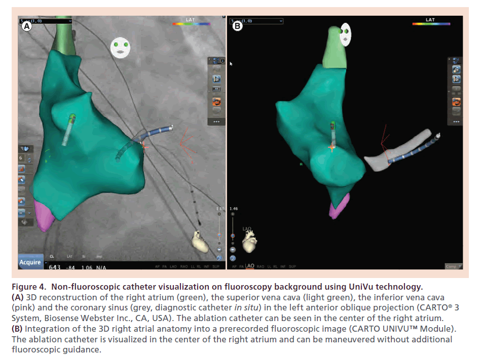 interventional-cardiology-Non-fluoroscopic-catheter