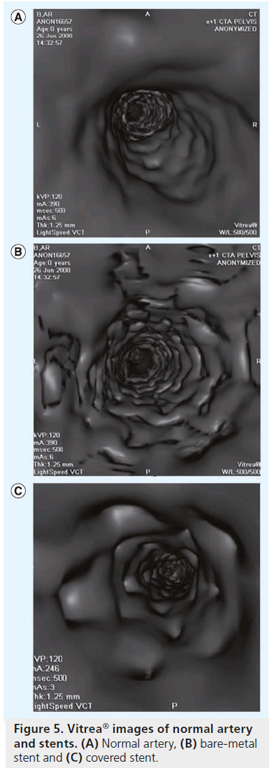 interventional-cardiology-Normal-artery