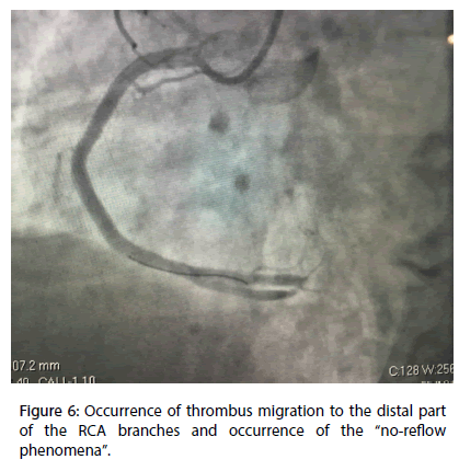 interventional-cardiology-Occurrence-thrombus