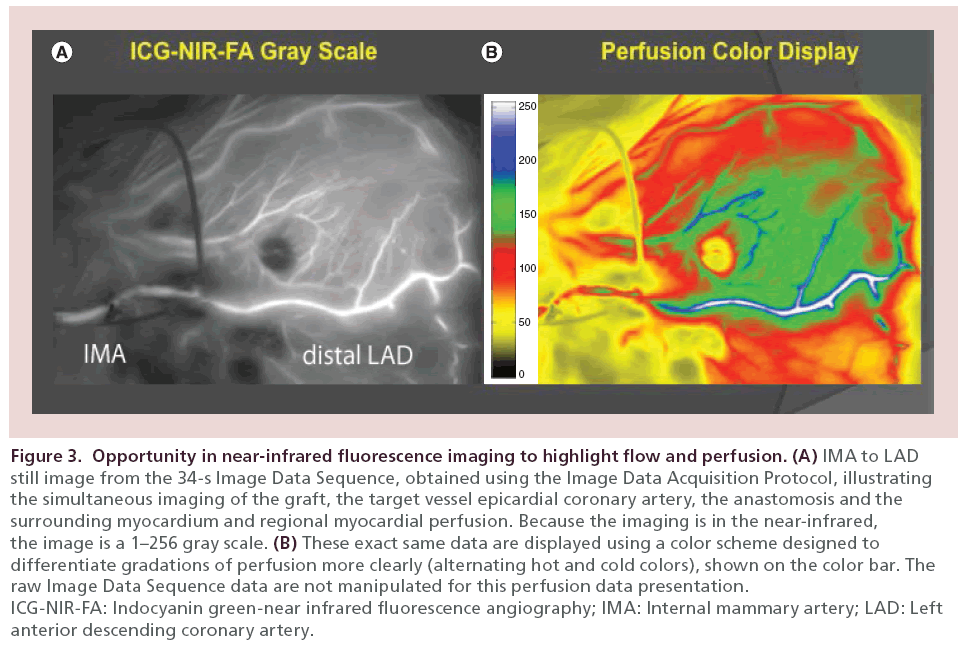 interventional-cardiology-Opportunity-near-infrared