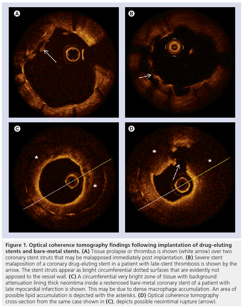 interventional-cardiology-Optical-coherence