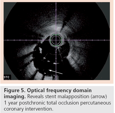 interventional-cardiology-Optical-frequency-domain