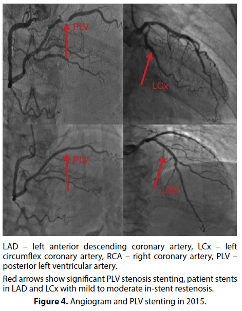 interventional-cardiology-PLV-stenting
