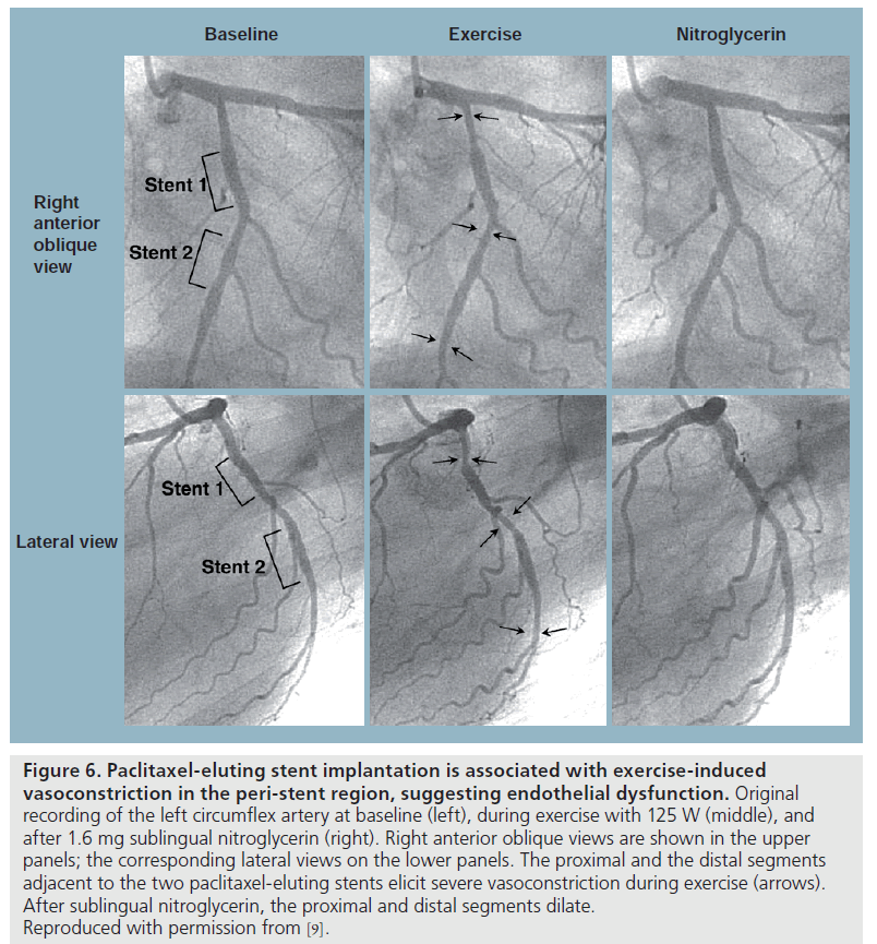 interventional-cardiology-Paclitaxel-eluting