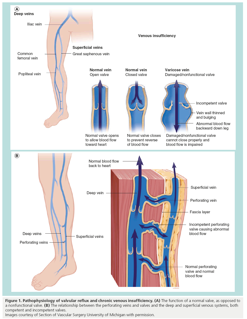 perforating veins insufficiency
