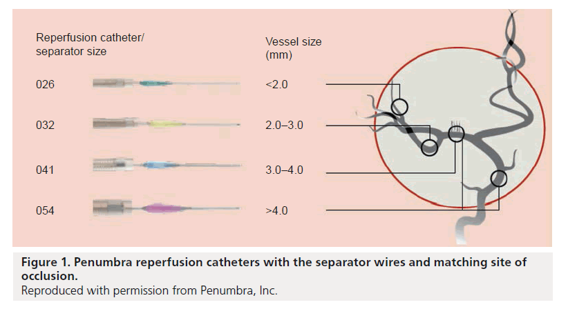 interventional-cardiology-Penumbra-reperfusion