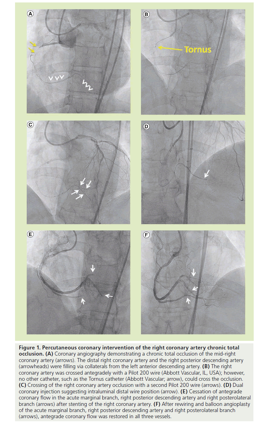 interventional-cardiology-Percutaneous-coronary