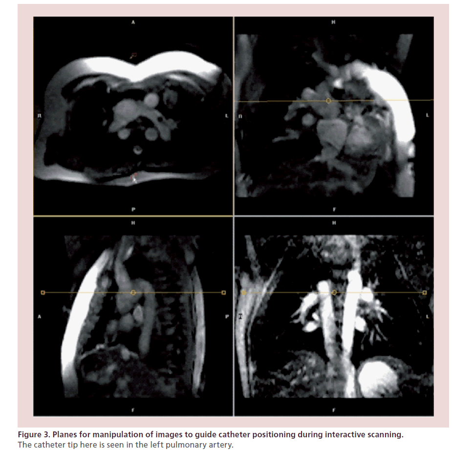 interventional-cardiology-Planes-manipulation