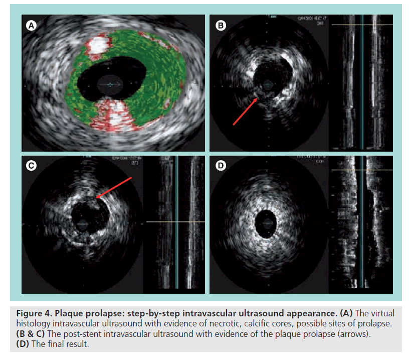 interventional-cardiology-Plaque-prolapse