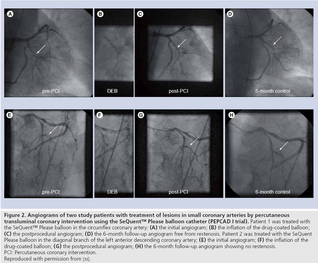 interventional-cardiology-Please-balloon-catheter