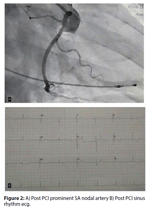 interventional-cardiology-Post-PCI
