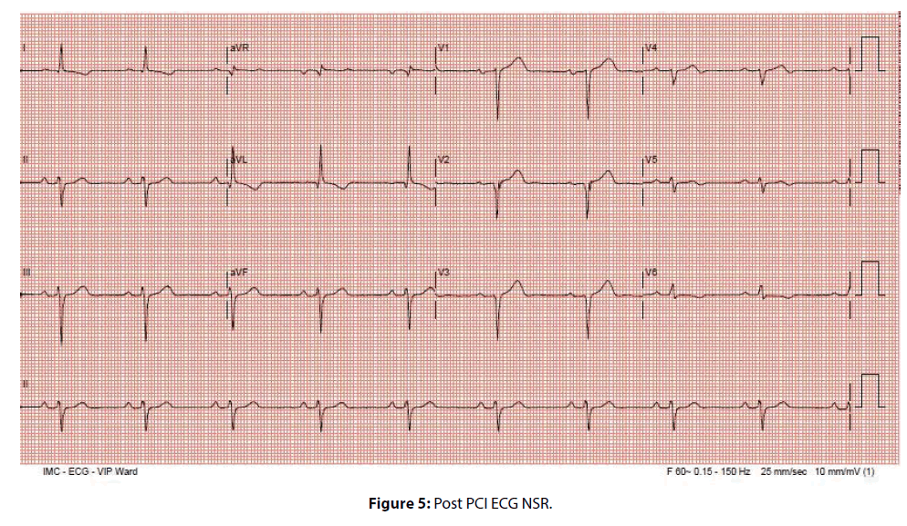 interventional-cardiology-Post-PCI