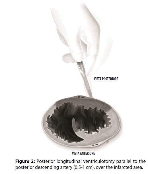 interventional-cardiology-Posterior-longitudinal