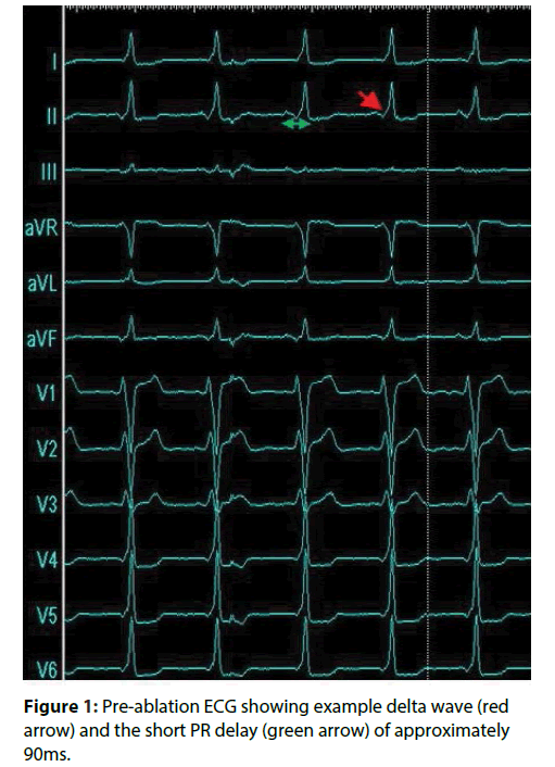 interventional-cardiology-Pre-ablation-ECG