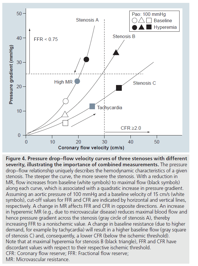 interventional-cardiology-Pressure-drop