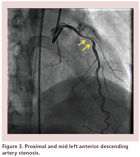 interventional-cardiology-Proximal-mid-left-anterior