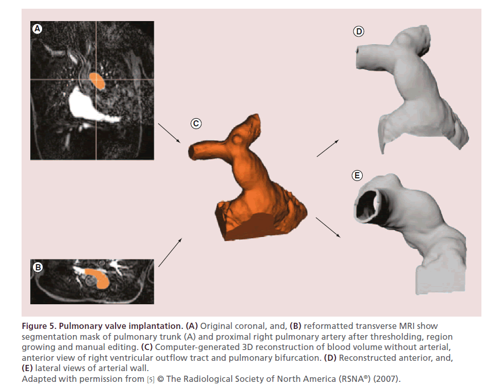 interventional-cardiology-Pulmonary-valve-implantation