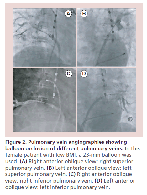 interventional-cardiology-Pulmonary-vein